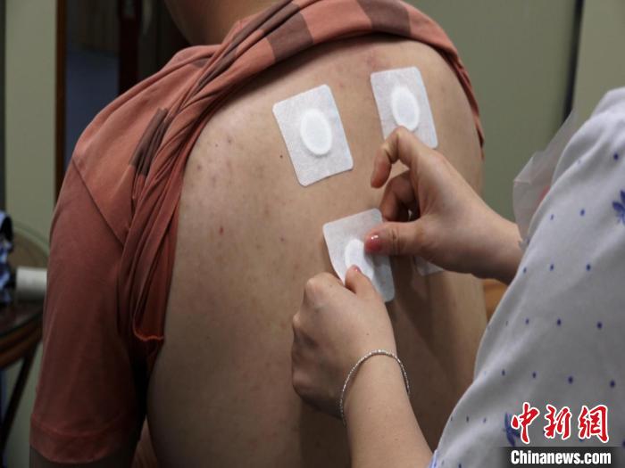 圖為醫(yī)生正在為民眾貼“三伏貼”?！√莆登?攝